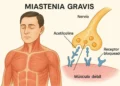 Miastenia gravis: características y desafíos de esta enfermedad poco común